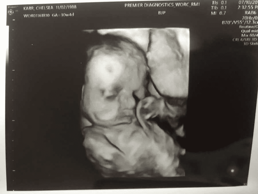 Are 3D ultrasounds accurate for looks