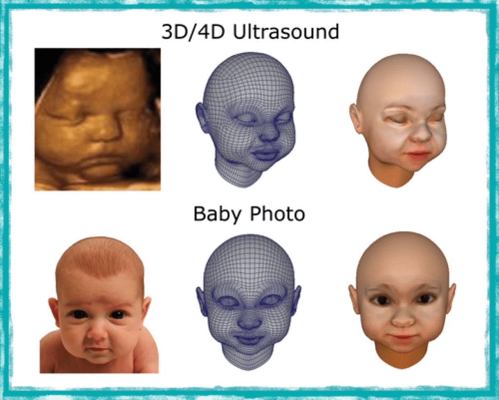 Baby's Nose Looks Wide On 3d Ultrasound